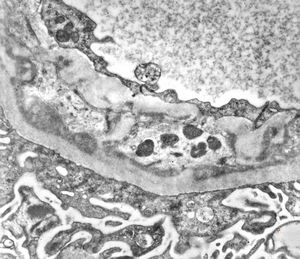 F,47y. | IgA nephropathy (Berger disease) F,47y. | IgA nephropathy (Berger disease)